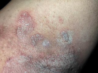 Dermatophytosis, also known as tinea and ringworm, a fungal infection of the skin