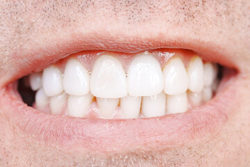 Obraz premium close-up. The man smiles and shows his teeth. oral hygiene. Dental veneers.