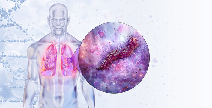 Lung infection caused by Legionella pneumophila bacteria. Respiratory system diseases: influenza, pneumonia, coronavirus SARS flu. Human lungs affected by streptococcus, staphylococcus, mycoplasma. 3D