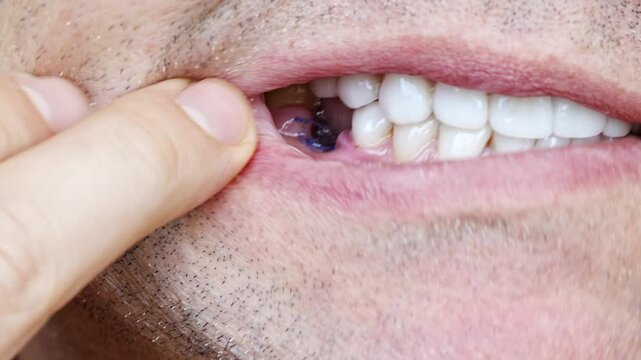 close-up. a sutured socket in the oral cavity after tooth extraction. the work of a dentist surgeon.
