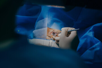 Eye surgery in a modern clinic. Vision correction