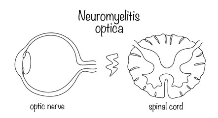 Neuromyelitis optica