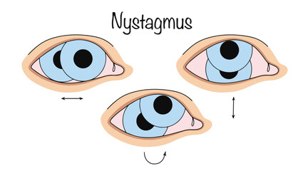 Nystagmus