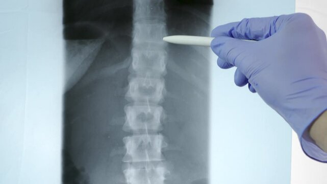 Doctor radiologically analyzing the spinal column with x-ray.
Hand of a doctor analyzing and pointing with a pen to the affected area.