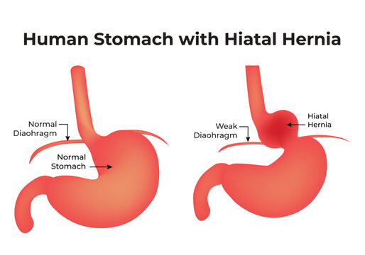 Human Stomach With Hiatal Hernia Normal Diaphragm Normal Stomach Weak Diaphragm Hiatal Hernia  Science Vector Illustration