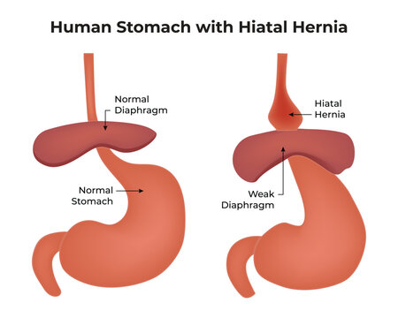 Human Stomach With Hiatal Hernia Normal Diaphragm Normal Stomach Weak Diaphragm Hiatal Hernia  Science Vector Illustration
