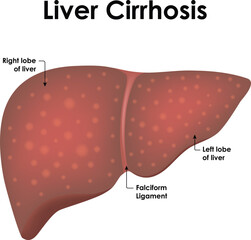 Liver Cirrhosis Anatomy Right And Left Lobe of Liver Falciform Ligament Vector Illustration