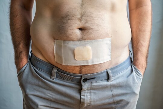 A partial view of a colostomy pouch attached to a person's abdomen, with a subtle hint of medical