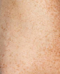 A person's arm has a patch of red skin