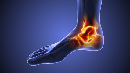 Obraz premium Pain and edema in the sprained ankle