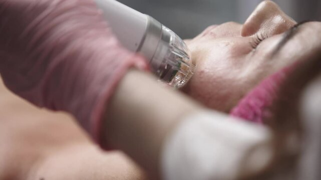 A close-up of the microneedle RF lifting procedure in a beauty salon. A young woman enjoys high-quality facial treatment, highlighting the significance of professional cosmetic procedures.