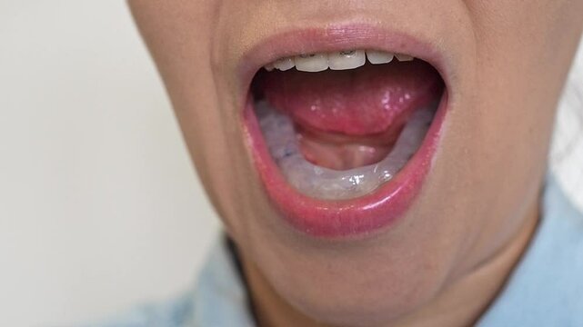 Woman puts dental splint guard in her mouth. TMJ splint disorder treatment. Occlusal splint. Prevent bruxism. Mouth guard for TMJ. Teeth protection. Pain in jaw. Teeth grinding.