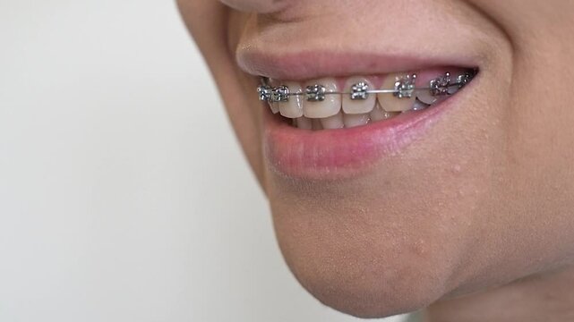 Close-up of a woman smile with braces on her teeth. 