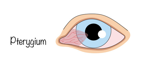 Pterygium