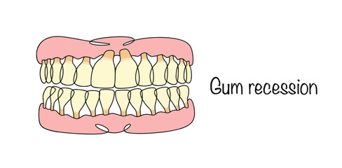 Gum recession