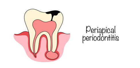 Periapical periodontitis