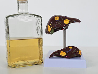 Alcoholic liver damage and liver cirrhosis concept with liver and alcohol