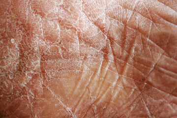 Closeup view of dry human skin .