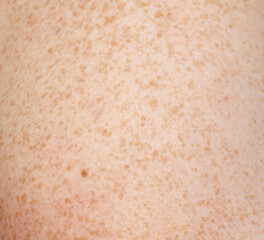 A person's arm has a patch of red skin