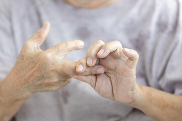 Senior woman suffering from Rheumatoid Arthritis,resembling Rheumatism,Rheumatoid disease,old...