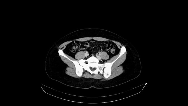 CT of the abdomen and pelvis of a 40-year-old woman. Axial view. Venous phase. Series description 5.0 B41s.