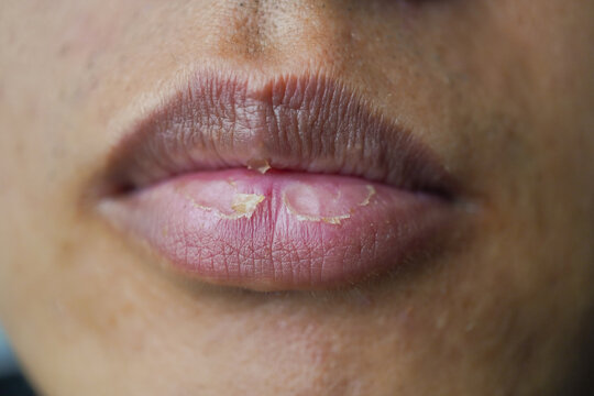 Close up photo of A man suffering from chapped lips. Concept for skincare and oral disease.