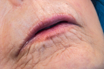 Obraz premium Medical themes: Female patient with scleroderma