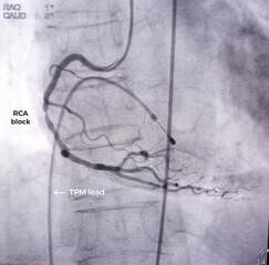 Coronary angiogram of right coronary artery during cardiac catheterization with dye. Findings abnormal, block are seen.