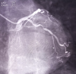 Coronary angiogram of left coronary artery during cardiac catheterization with contrast dye....
