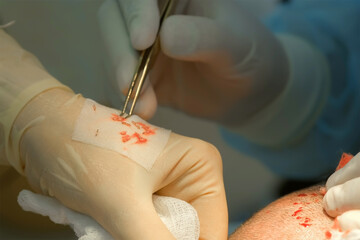 Surgeon takes out hair grafts from patient head using tweezers to hair transplant. Problem of baldness of men in middle age, treatment of alopecia by hair transplantation surgery in clinic hospital.