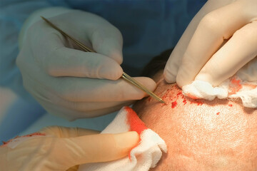 Surgeon takes out hair grafts from patient head using tweezers to hair transplant. Problem of baldness of men in middle age, treatment of alopecia by hair transplantation surgery in clinic hospital.