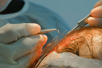 Procedure of hair transplantation on head of bald man in clinic. Surgeon transplants hair grafts to head scalp uses tweezers on surgery in clinic. Problem of baldness, treatment alopecia in hospital.