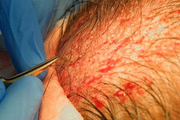 Surgeon make hair transplantation on head of bald man, alopecia cure in clinic. Operation transplants hair grafts to head scalp uses tweezers on surgery. Problem male baldness, treatment in hospital.