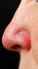 Fototapeta premium Bulbous Red Nose with Severe Rosacea, Highlighting Prominent Capillaries and Skin Texture