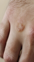 Close-Up View of Granuloma Annulare on Hand Highlighting Distinctive Raised Ring-Shaped Lesions for Dermatological Study