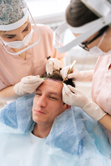 Closeup vertical shot of trichologist surgeons carry out hair FUE Sapphire method hair transplant...