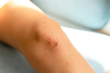 Healing process of a scraped knee showing a wound on a child's elbow in soft, natural light indoors...