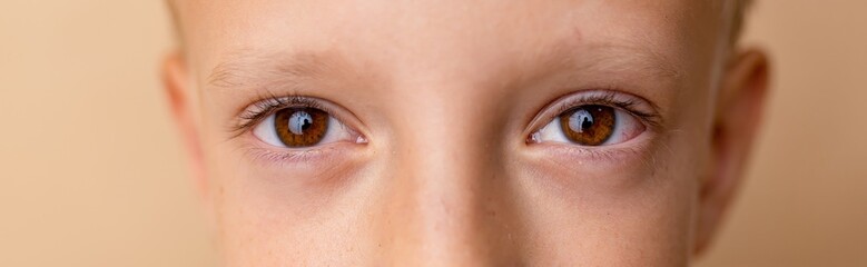 Close up. Red eyes with conjunctivitis, viral on eye. Allergy to pollen. Irritated red bloodshot...