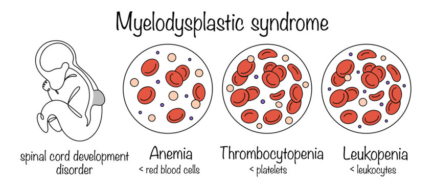 Myelodysplastic syndrome