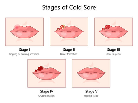 cold sore, from the initial tingling sensation to blister formation, ulcer eruption, crusting, and healing diagram hand drawn schematic vector illustration. Medical science educational illustration