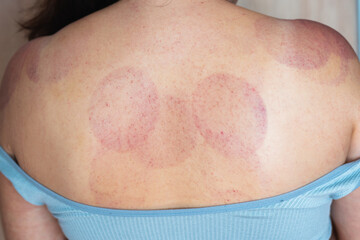 Hematomas on a woman's shoulders and back after a cupping massage procedure