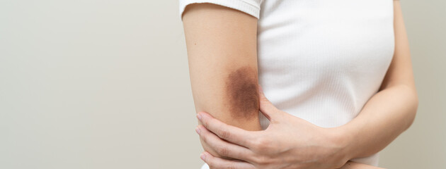 Close up of stain bruise wound on arm, contusion asian young woman, girl an accident fell down...
