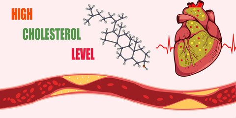 Illustration of Cholesterol's Impact on Heart and Arteries.

