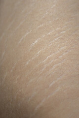 Fototapeta premium Stretch Marks on Groin Area – Skin Texture and Health Concept