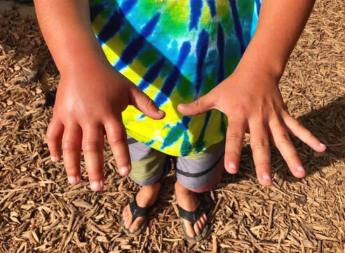 Allergy caused by an insect bite on a child's hand.