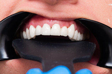 Close vup of crystal white teeth, showcasing the exceptional results of a dedicated dental team.