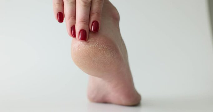 Woman touches dry and cracked heel feeling rough texture. Female feels uneven texture of heel. Lady feels discomfort caused by cracked skin
