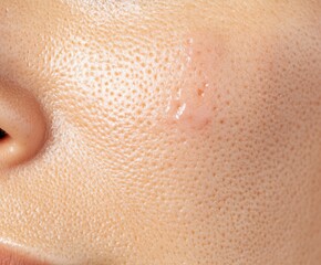 A closeup of problematic skin with visible acne and redness before treatment, set against a neutral background, ideal for skincare tutorials and product use.
