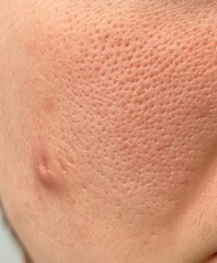 A closeup of problematic skin with visible acne and redness before treatment, set against a neutral background for skincare tutorials and product use.