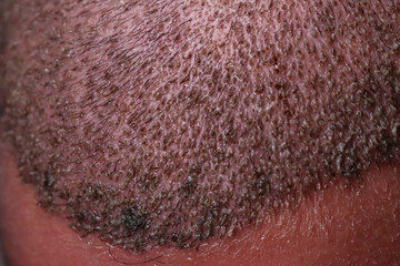 The head of a man seen from above after hair implantation in the follicles